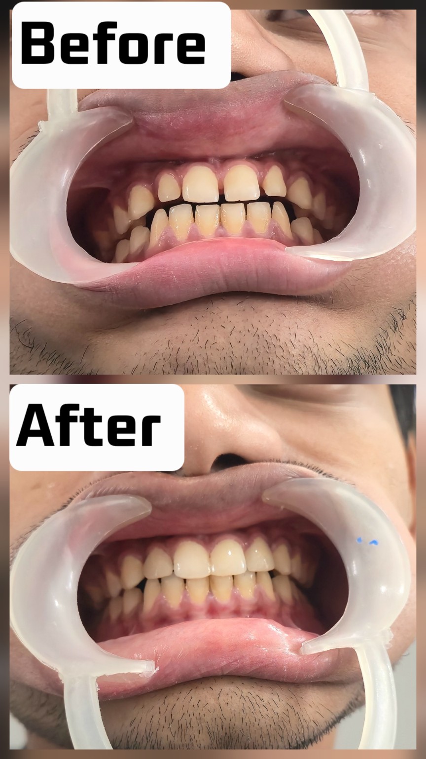 Smile alignment improvement before and after result